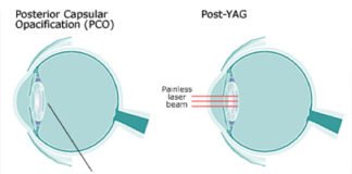 YAG Laser Post Cataract Surgery