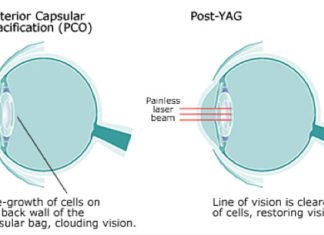 YAG Laser Post Cataract Surgery